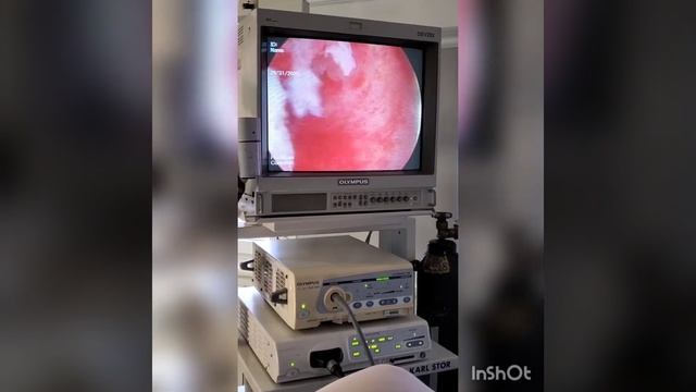 Гистероскопия, удаление полипа эндометрия. Hysteroscopy, polypectomy смотреть онлайн