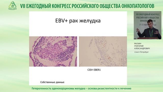 Гетерогенность аденокарциномы желудка – основа резистентности к лечению смотреть онлайн