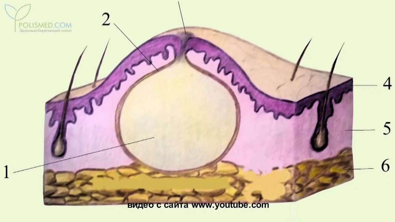 Школа здоровья: доброкачественные новообразования смотреть онлайн
