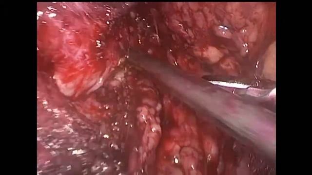 Laparoscopic Transperitoneal Prostatectomy / Лапароскопическая простатэктомия смотреть онлайн
