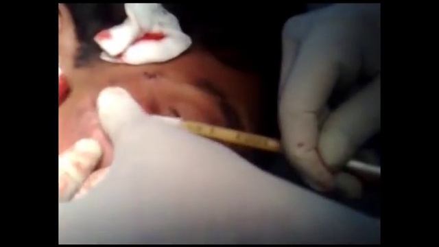 Acne Scar Subcision смотреть онлайн