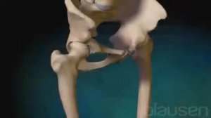 Перелом бедренной кости Реабилитация после перелома шейки бедра