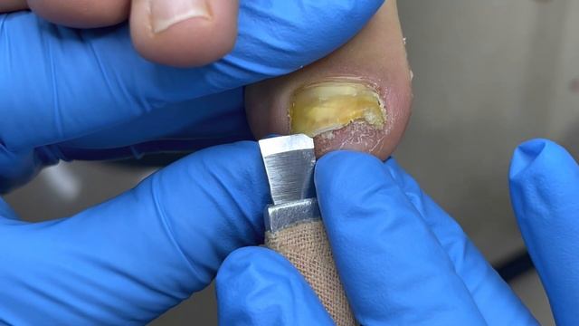 Pedicure Tutorial：Trim Off Bad Nails【Pedicure Master Lin Jun】