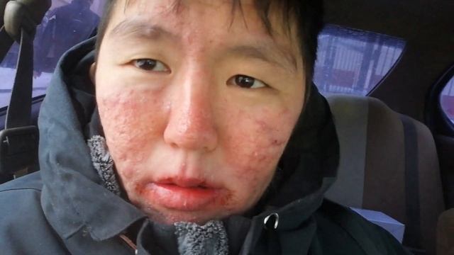 Лечим прыщ , Акне ! Роаккутан ! 33 день ! Диета!Лазерный пиллинг! смотреть онлайн