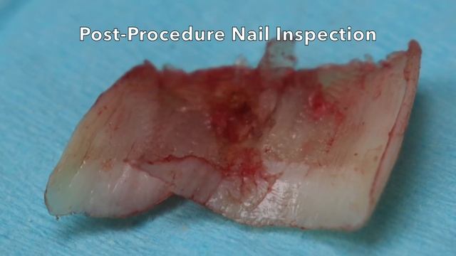 RIPPING OFF A TOENAIL AND FINDING... смотреть онлайн