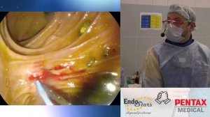 Эндоскопическое стентирование холедоха. С. В. Кашин, Д. В. Гусев, Е. Л. Тарасова