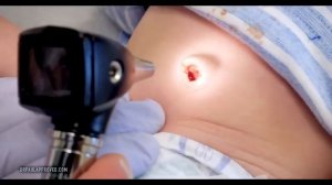 UMBILICAL GRANULOMA COMPILATION | Dr. Paul