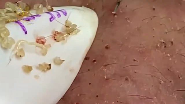 Relax Squeezing Out Blackheads #46 Черные точки