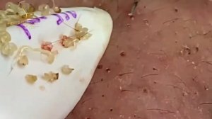 Relax squeezing out blackheads #46 Черные точки