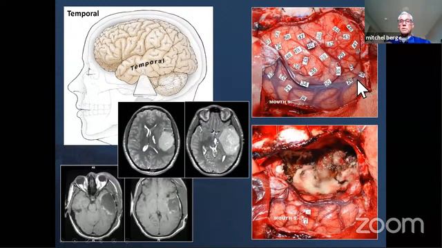 Brain Mapping for Glioma Resection смотреть онлайн