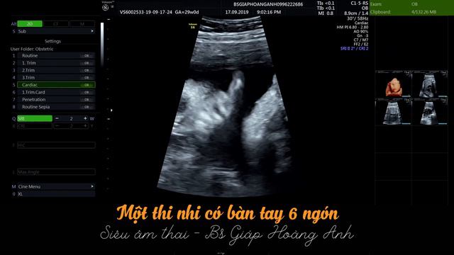Siêu âm thai - Bàn tay thai nhi có 6 ngón tay - không thể chủ quan! смотреть онлайн