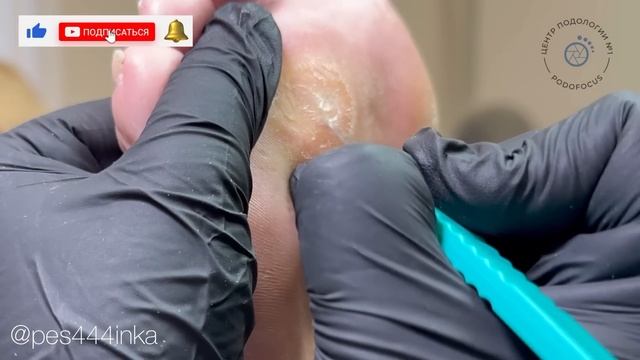 ?МОЗОЛЬ на ноге / как убрать мозоль / курсы подологии смотреть онлайн