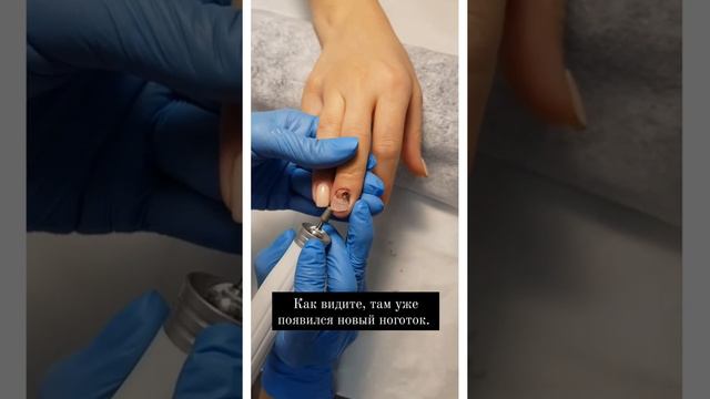 Спасаем ноготь после травмы смотреть онлайн