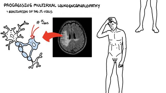 Opportunistic Infections And AIDS-defining Illnesses - CD4+ Cell Count, Malignancy, Treatment