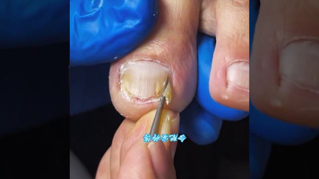 Deeply Clean the Yellow Impurities Under the Nails!#magicknife смотреть онлайн