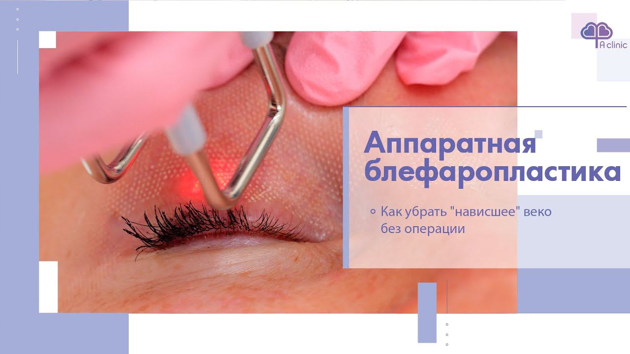 Безоперационная лазерная блефаропластика Москва смотреть онлайн