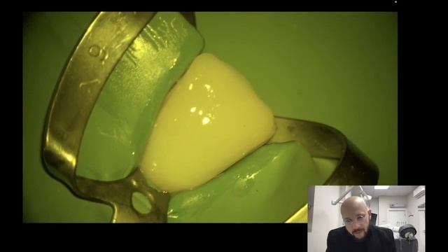 Фрагмент вебинара о Bleach-реставрациях смотреть онлайн