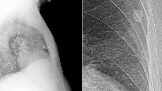 Tuberculoma X-ray Experiment | X-ray | Radiological Survey Images смотреть онлайн