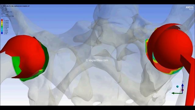 ANSYS WB Static Structural FEA - Legs movement simulation for hip replacement implant смотреть онлайн