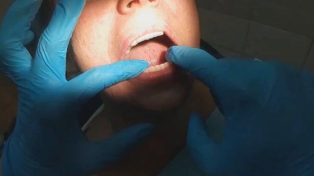 Бюджетное протезирование пациентки "Ш". 1 часть. Обучающее видео для вр.-интернов. 4-я стоматология смотреть онлайн