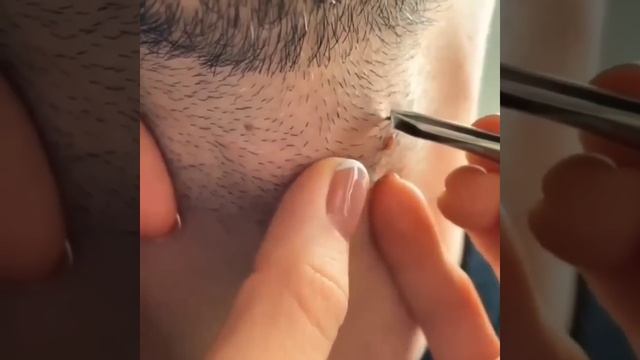 Blackheads Extractions-this Week | Massive Old Blackhead On The Neck