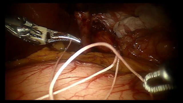 Robot-assisted fundoplication Nissen//Робот-ассистированная фундопликация по Ниссену (Full video) смотреть онлайн