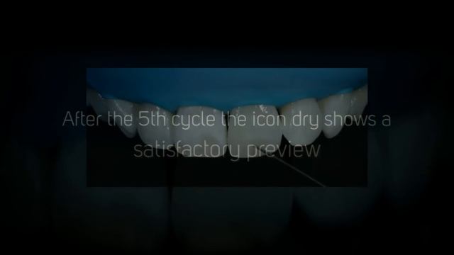 Helping Dentists Succeed: ICON resin infiltration for white spot removal смотреть онлайн