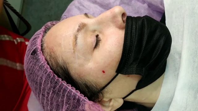 Заполнение виска филером PLLA