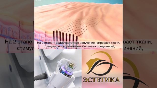Процедура "Микроигольчатый РФ-лифтинг" смотреть онлайн