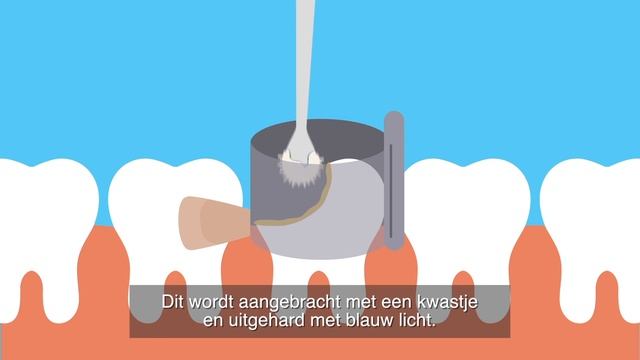 Een gaatje vullen bij de tandarts смотреть онлайн