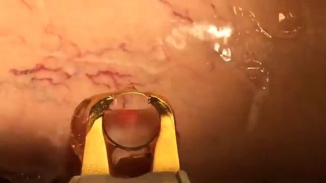 Excel V Vein Treatment | Beverly Hills Med Spa Dr. Motykie смотреть онлайн