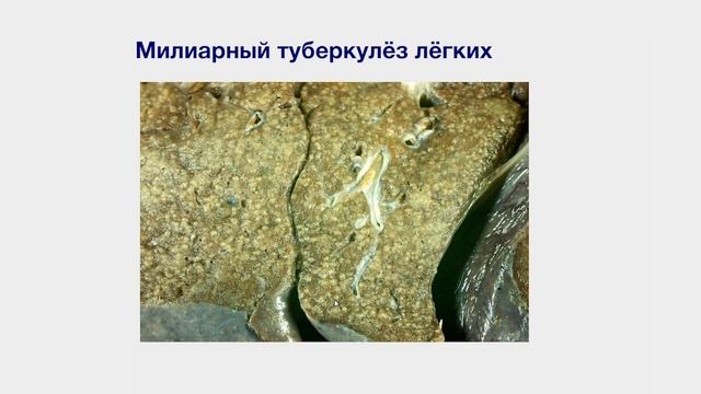 Туберкулез: этиология, патогенез, морфогенез, классификация, осложнения, исходы. Часть 2 смотреть онлайн