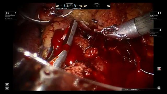 Robotic partial nephrectomy 6 tumors Роботическая резекция почки 6 опухолей смотреть онлайн