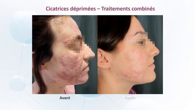 Peeling de bio-revitalisation PRX-T33 смотреть онлайн