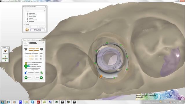 simedaCAD (exoCAD) ABUTMENT WITH COPING смотреть онлайн