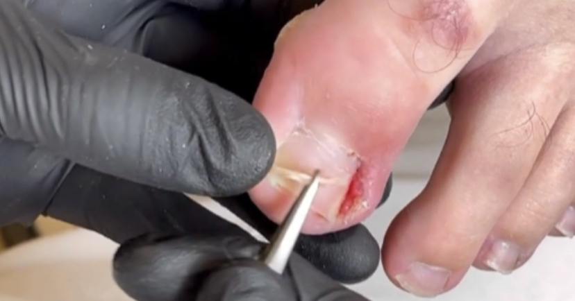 Вросший ноготь