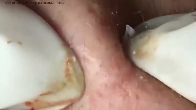 How to Get Rid of Blackheads & Whiteheads on The Face Easy ~ Acne Treatmen #12 смотреть онлайн