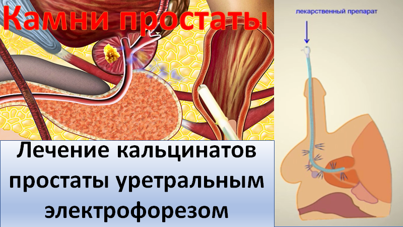 Лечение кальцинатов простаты уретральным электрофорезом смотреть онлайн