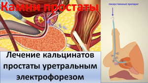 Лечение кальцинатов простаты уретральным электрофорезом