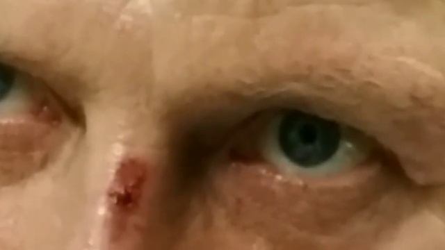 Nystagmus (нистагм)