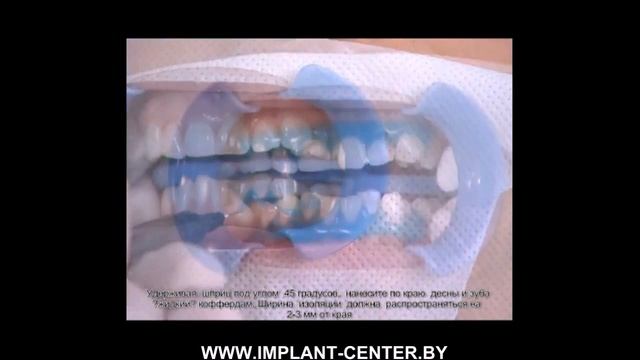 Отбеливание зубов Минск Beyond Polus смотреть онлайн