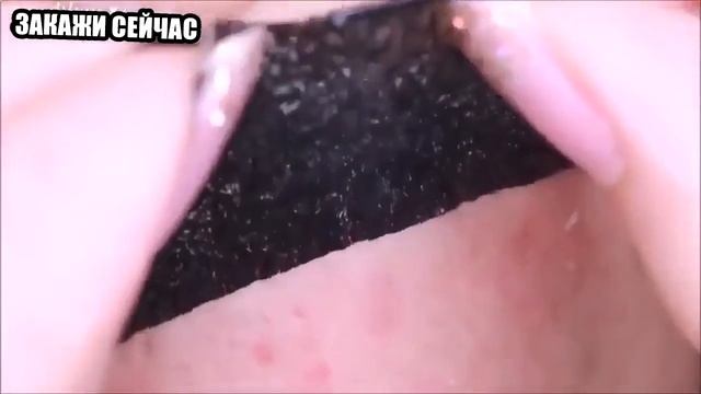 маска из угля от прыщей смотреть онлайн