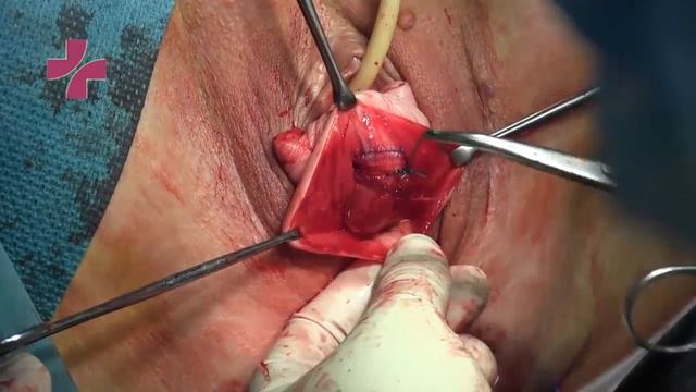 Симультанная гибридная реконструкция тазового дна передне-задне-апикальная смотреть онлайн