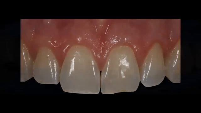 Tips and tricks for invisible Class IV's смотреть онлайн