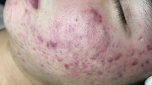 Как избавиться от прыщей на лице - Beauty SPA, 2021