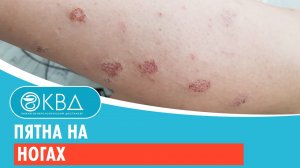 Пятна на ногах. Клинический случай №108