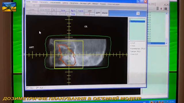 Планирование лучевой терапии в КСДП PLANW-2000