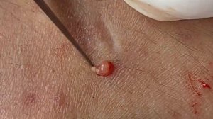 Четкие прыщи.Скрытые прыщи