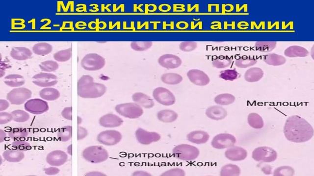 ЧТО ТАКОЕ АНИЗОЦИТОЗ В ОБЩЕМ АНАЛИЗЕ КРОВИ И ЧТО ЭТО ЗНАЧИТ