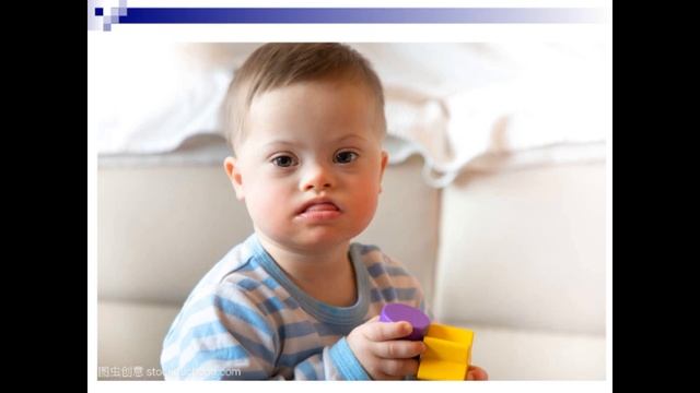 Down Syndrome(Trisomy-21) Genetic Diseases Series 1